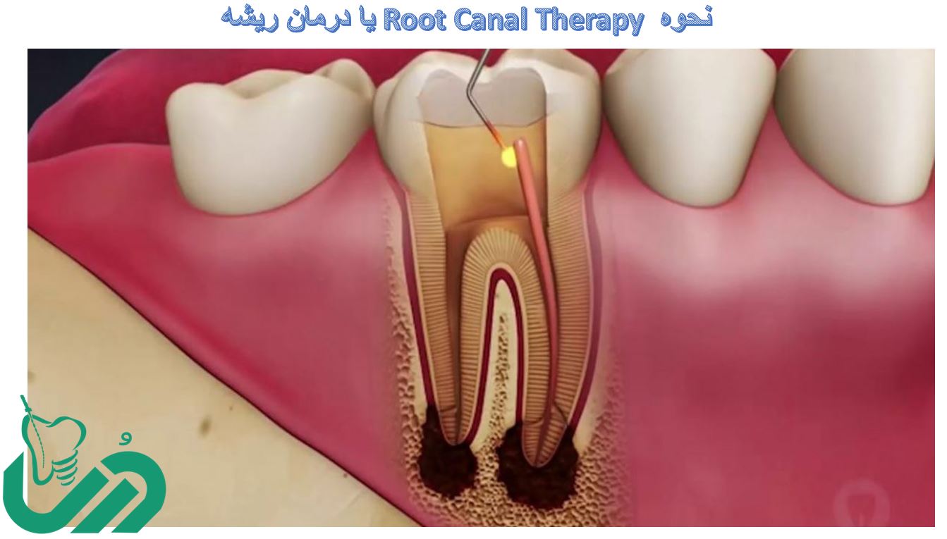نحوه درمان ریشه دندان