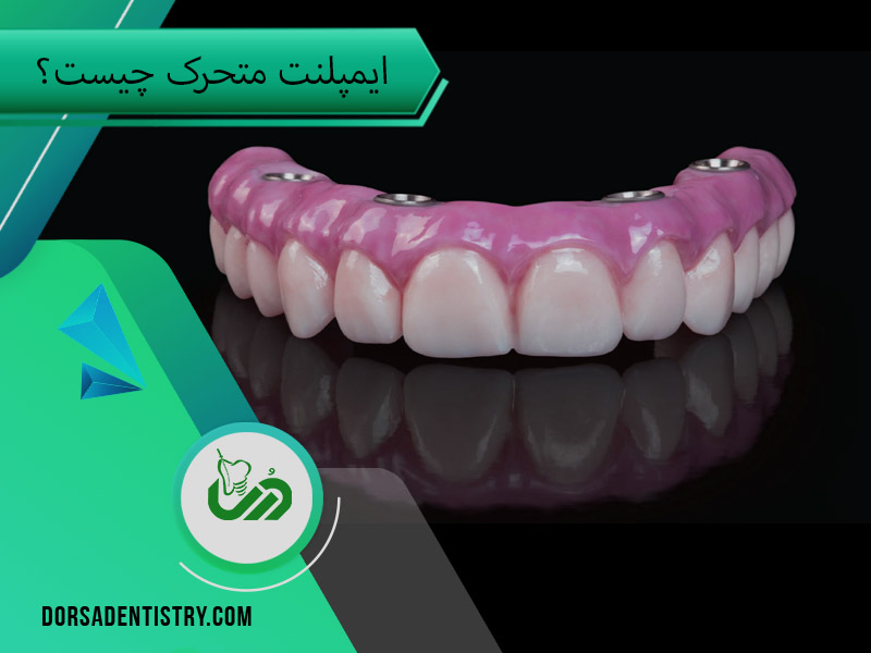 ایمپلنت متحرک چیست؟