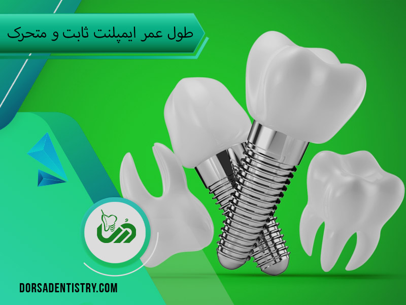 طول عمر ایمپلنت ثابت و متحرک