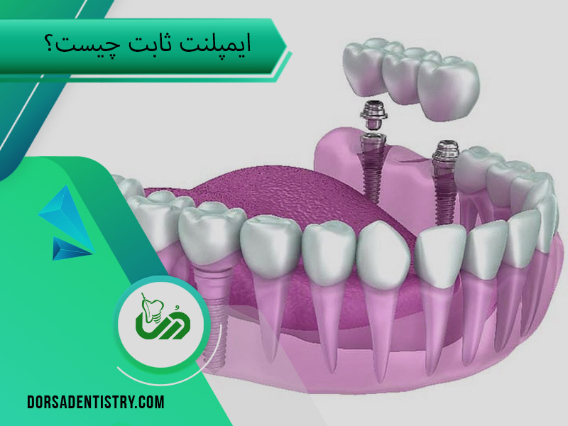 ایمپلنت ثابت چیست؟