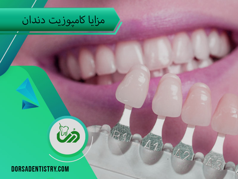 مزایای کامپوزیت دندان