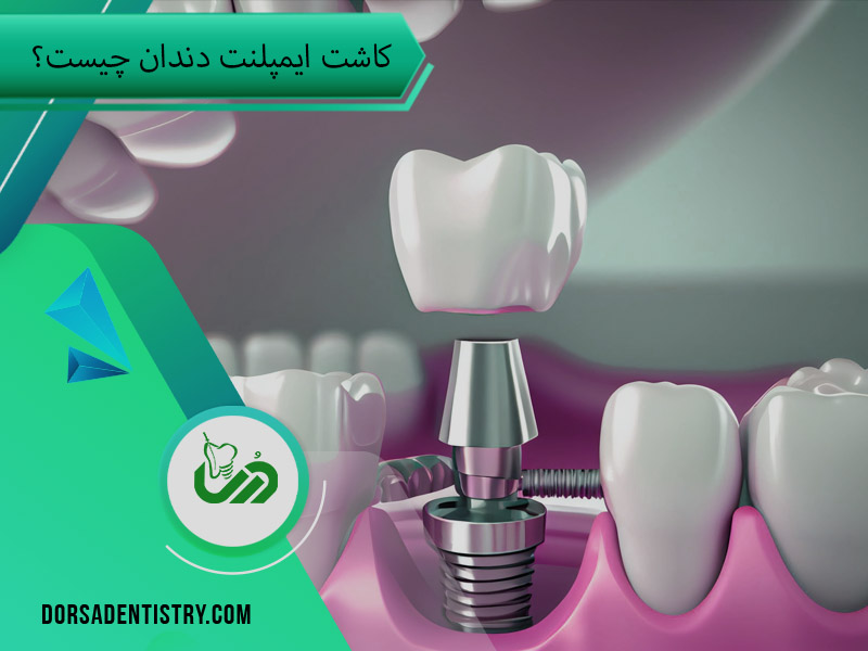 معرفی ایمپلنت دندان