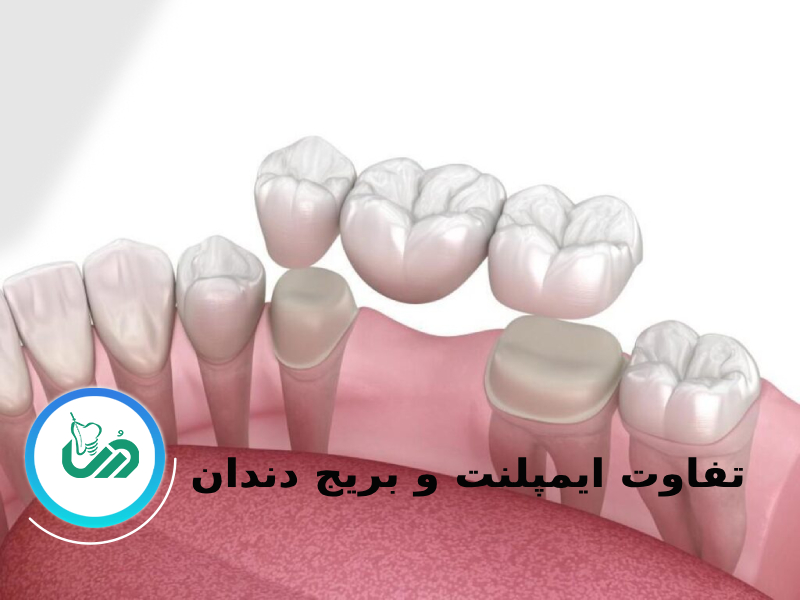 تفاوت ایمپلنت و بریج دندان