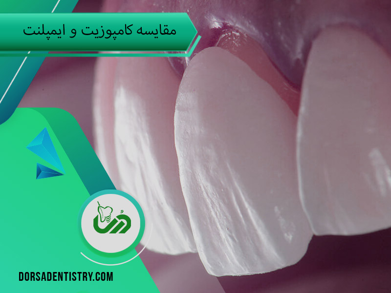 مقایسه کامپوزیت و ایمپلنت