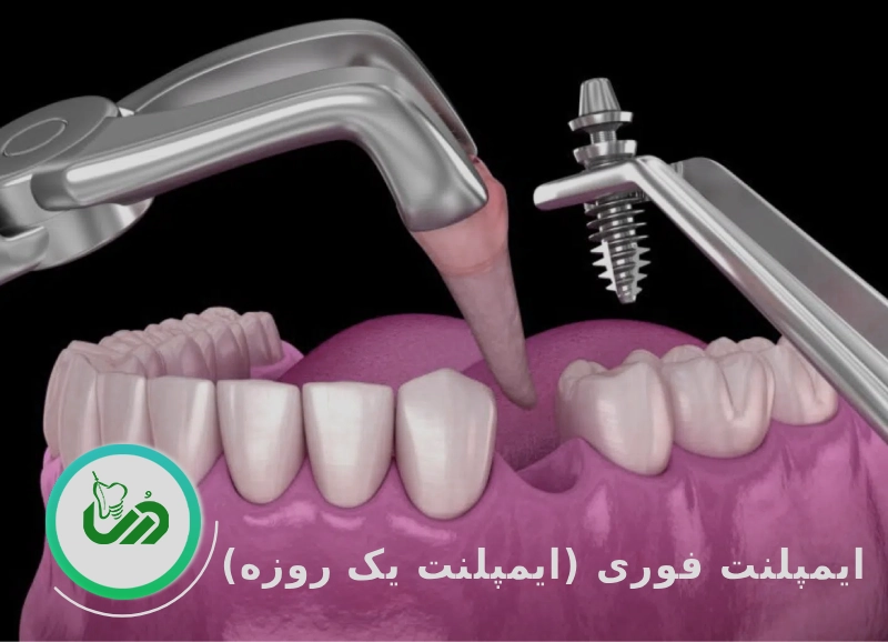 ایمپلنت فوری یا ایمپلنت یک روزه