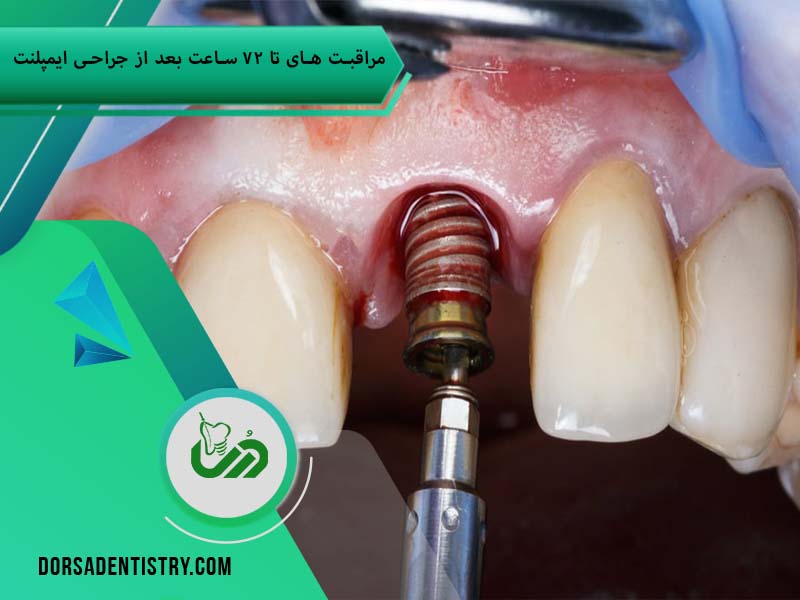 مراقبت های پس از ایمپلنت دندان