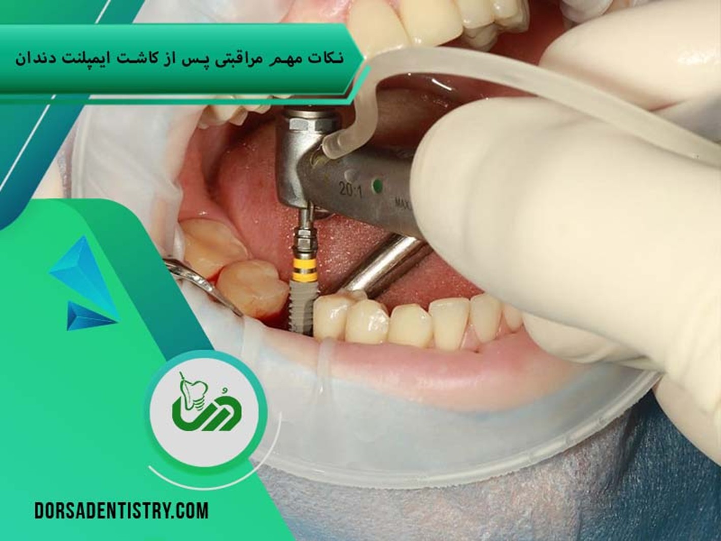 نکات مهم بعد از کاشت ایمپلنت دندان