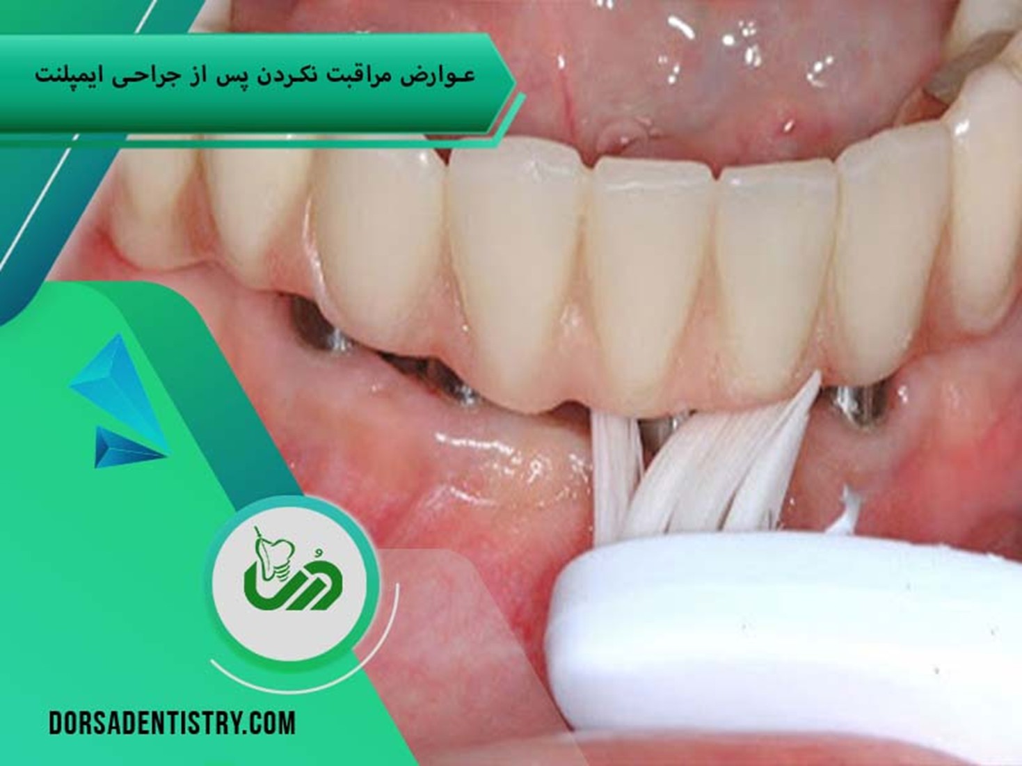 عوارض مراقبت‌نکردن از ایمپلنت بعد از کاشت