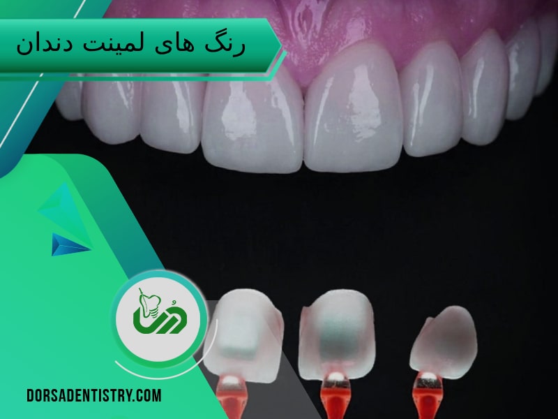 رنگ های لمینت دندان