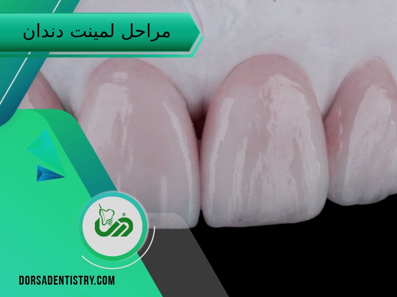 مراحل لمینت دندان