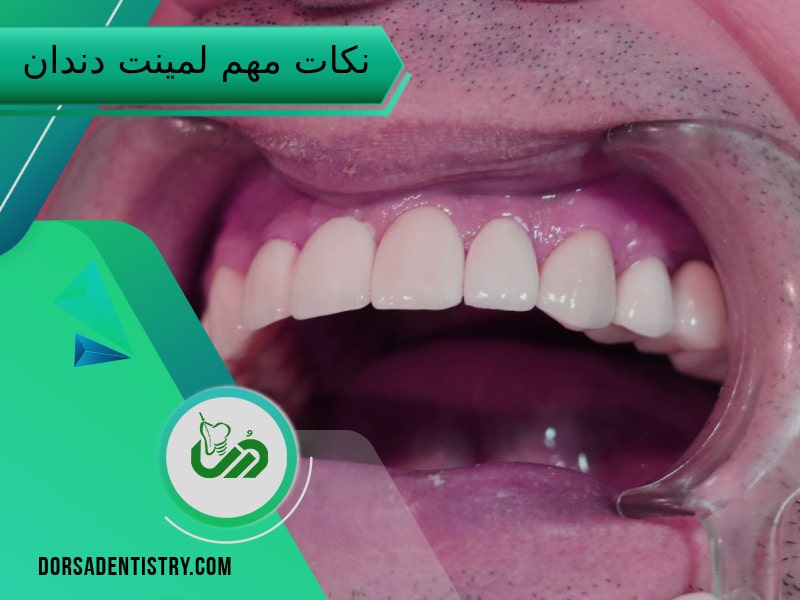 نکات مهم ایمپلنت دندان