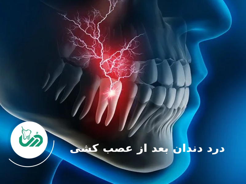 درد دندان بعد از عصب کشی