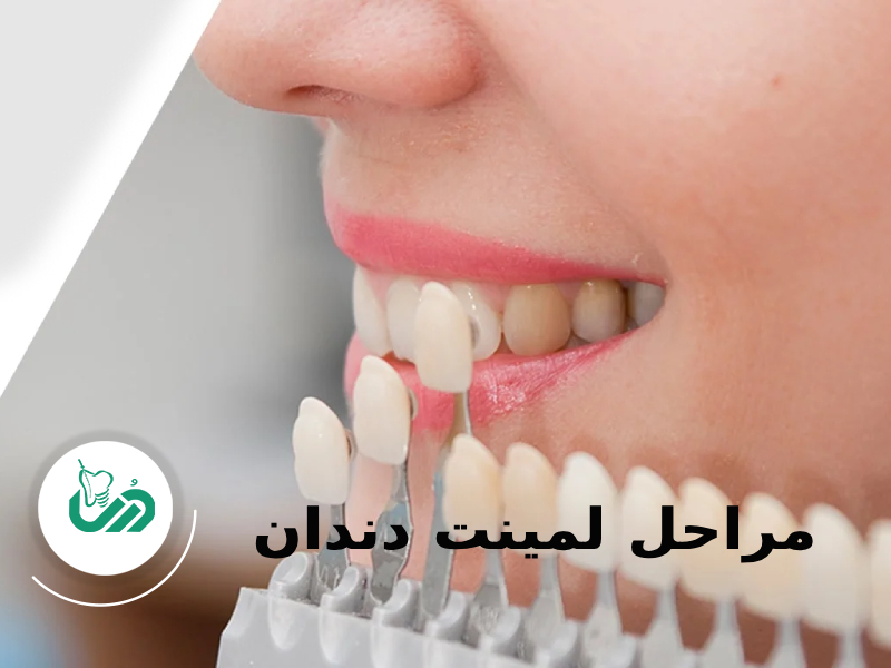 مراحل لمینت دندان