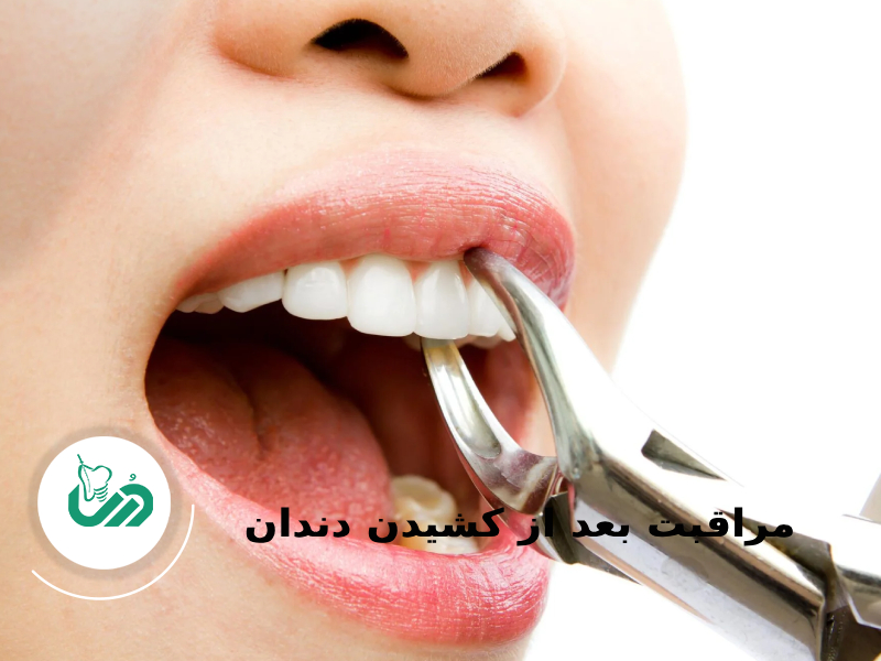 مراقبت بعد از کشیدن دندان