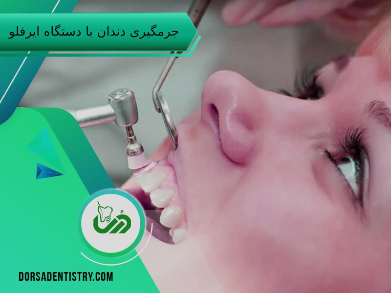 جرمگیری دندان با بهترین روش