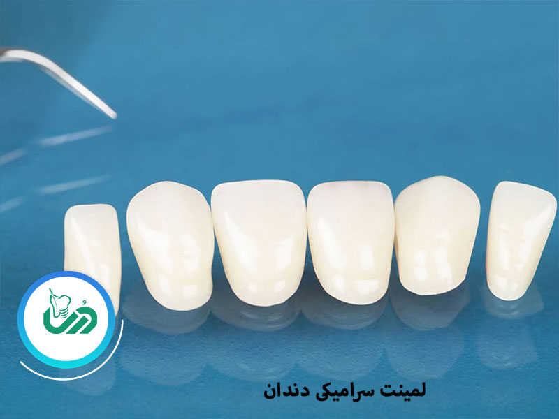 لمینت سرامیکی دندان