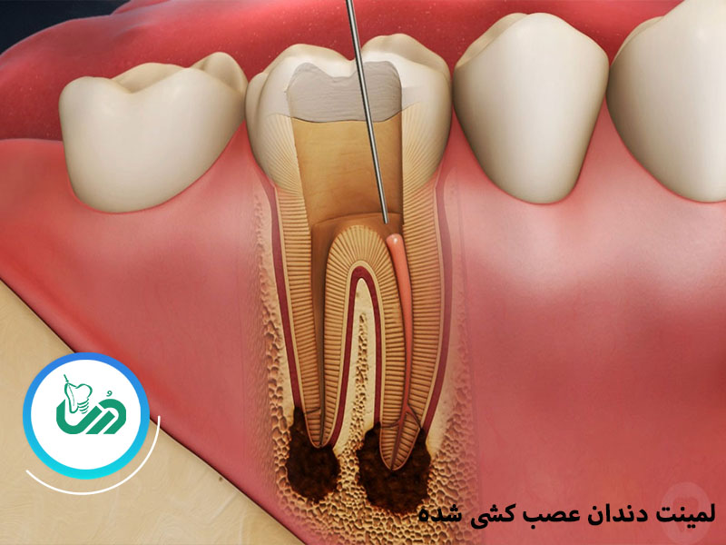 لمینت دندان عصب کشی شده