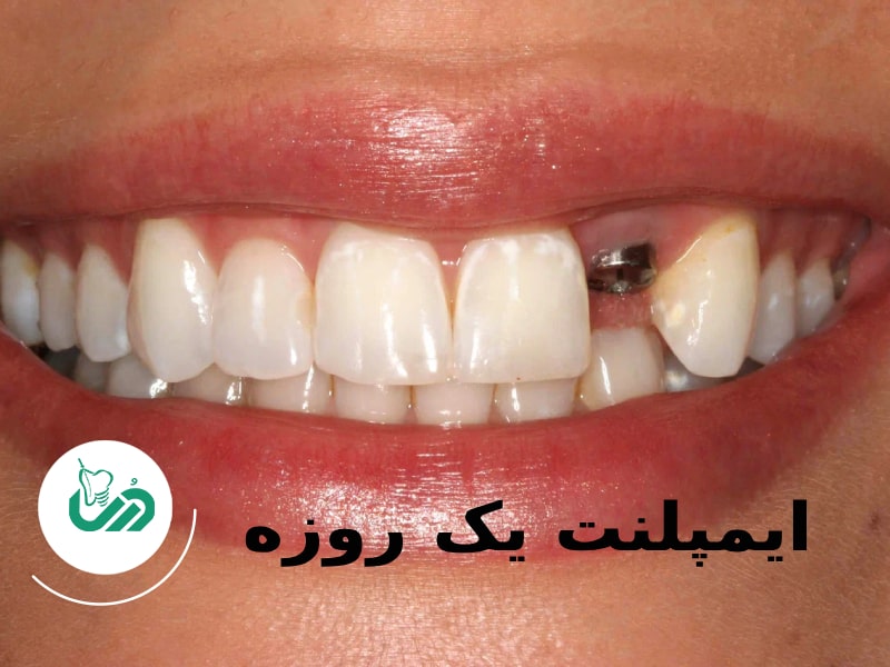 ایمپلنت یک روزه