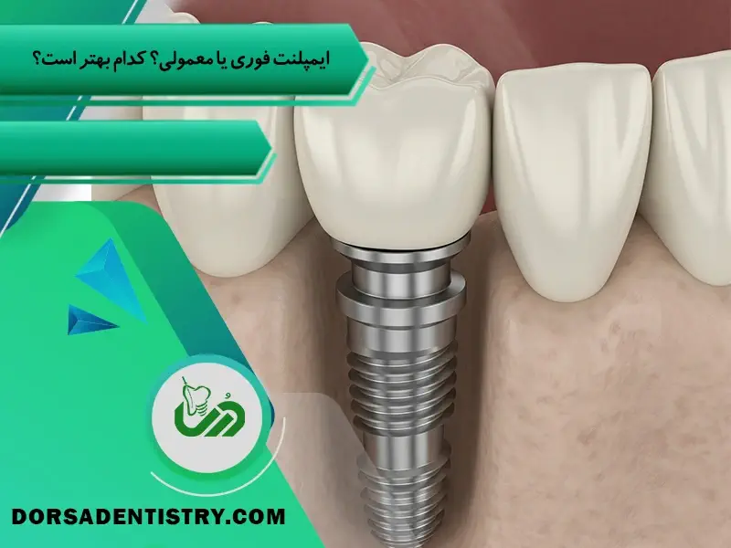ایمپلنت فوری یا معمولی؟ کدامیک بهتر است؟