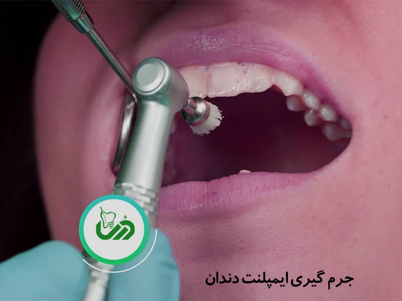 جرم گیری ایمپلنت دندان
