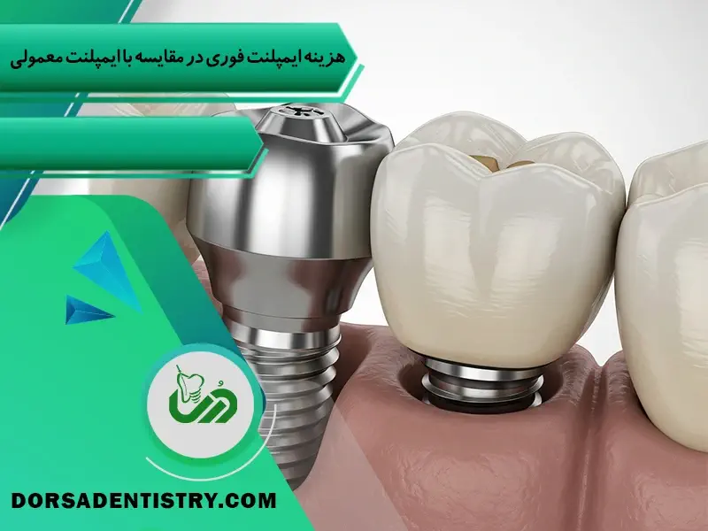 هزینه ایمپلنت فوری و معمولی چقدر است؟