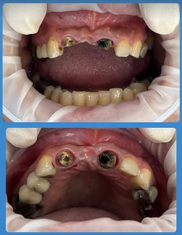 ایمپلنت یک روزه در مشهد