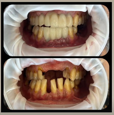 ایمپلنت فوری در مشهد