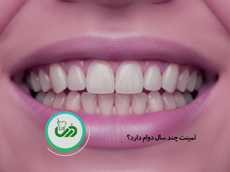 لمینت دندان چند سال دوام دارد؟