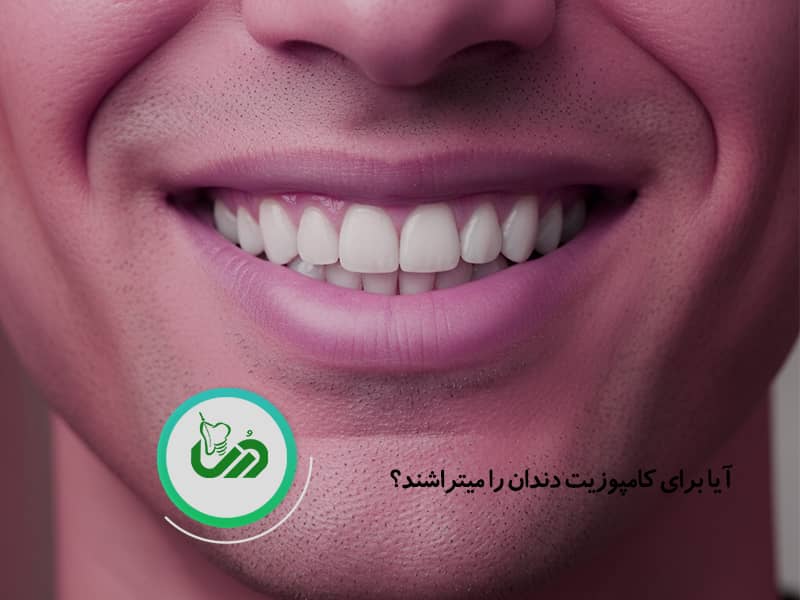 آیا برای کامپوزیت دندان را تراش میدهند؟