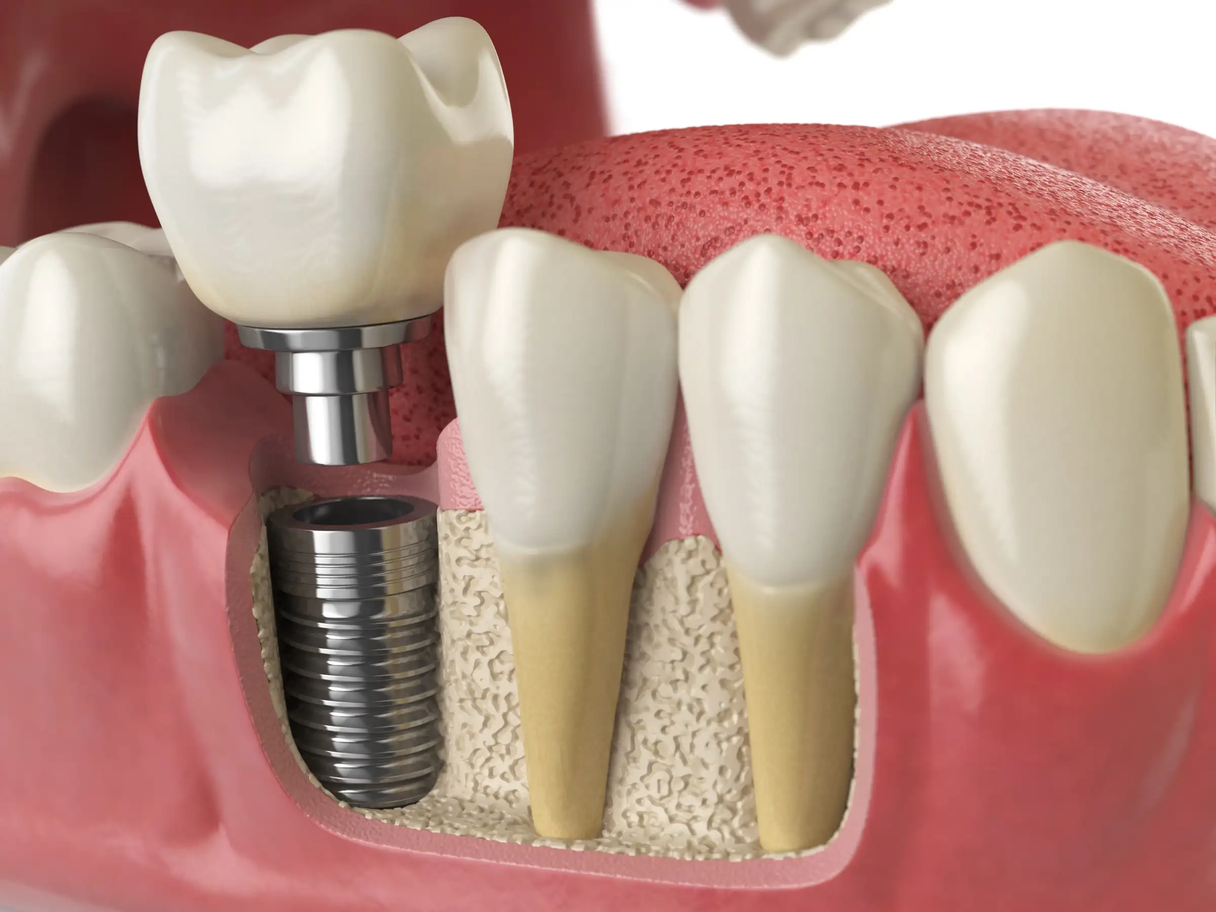Implant crown